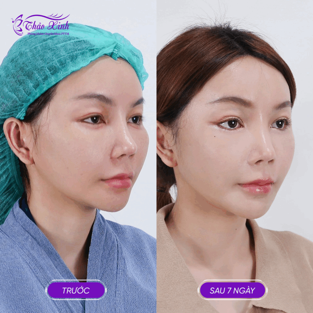 Mở Rộng Góc Mắt Trong/Ngoài 3