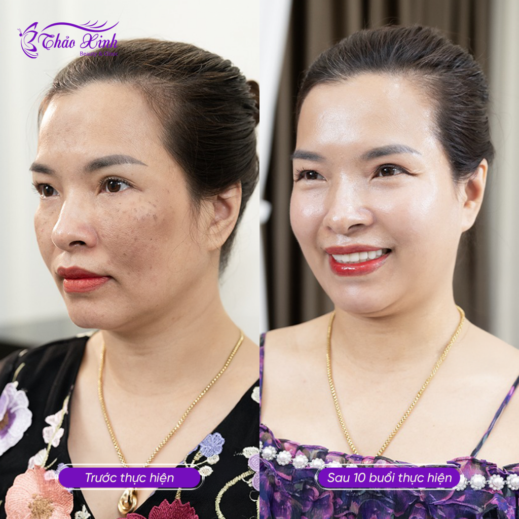 Điều Trị Nám Tổng Hợp 9