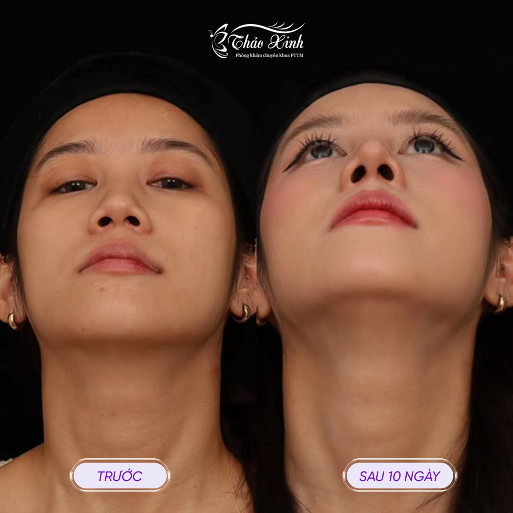 Tạo Hình Lỗ Mũi Hạt Chanh 6