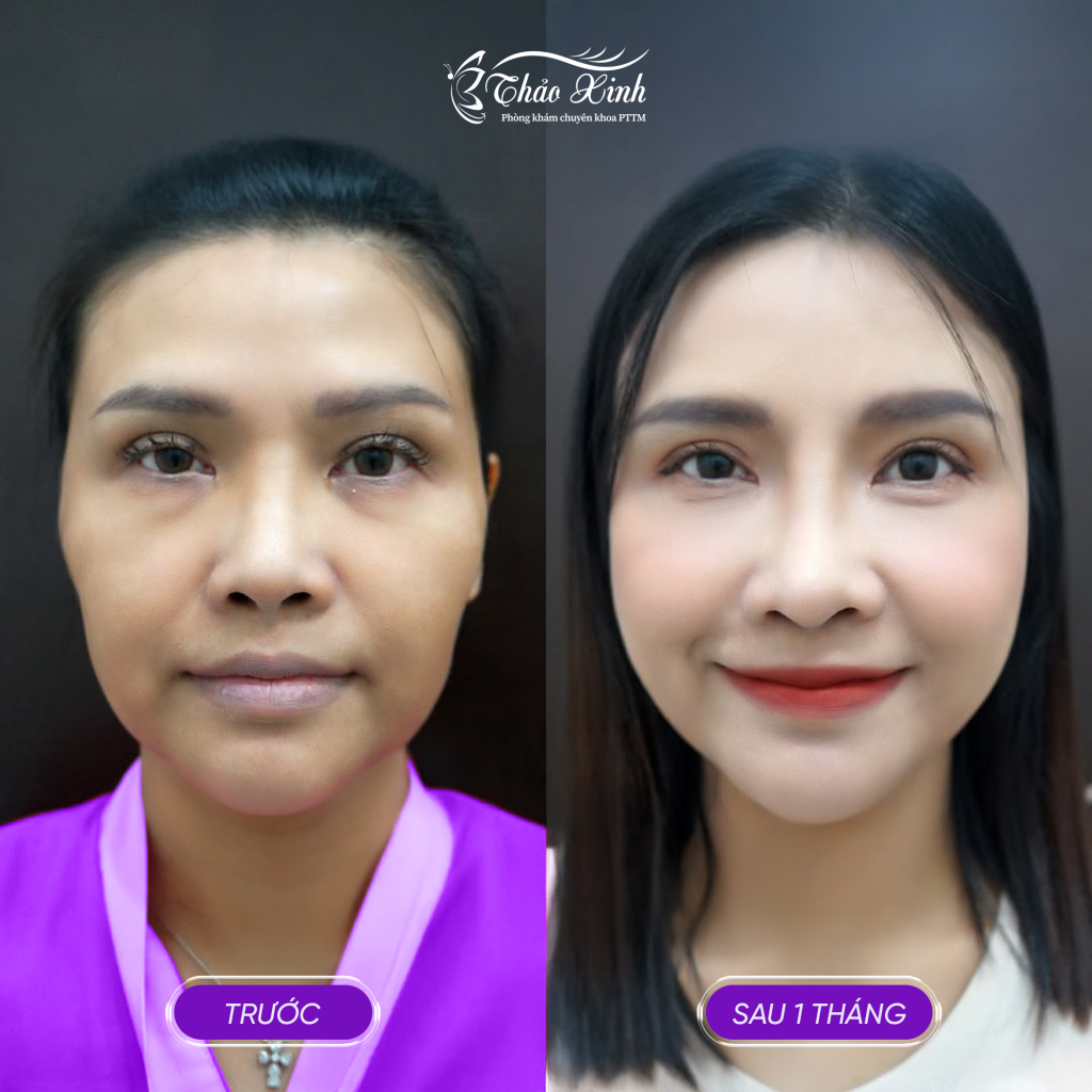 Cấy Mỡ Má Tự Thân 5
