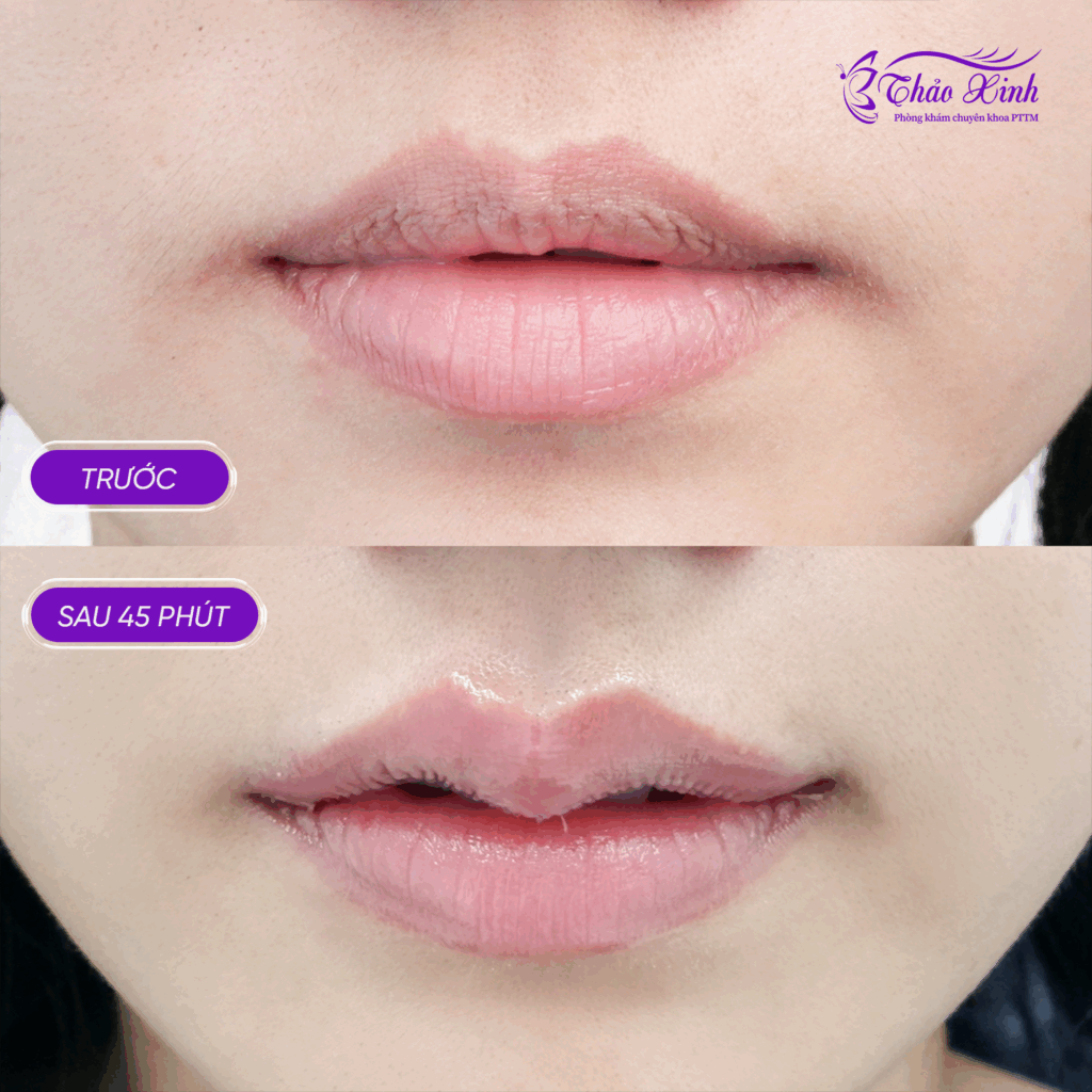 Tạo Hình Môi Trên 7