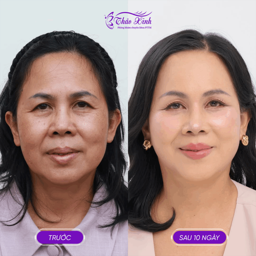 Căng Da Mặt Smas Face 4