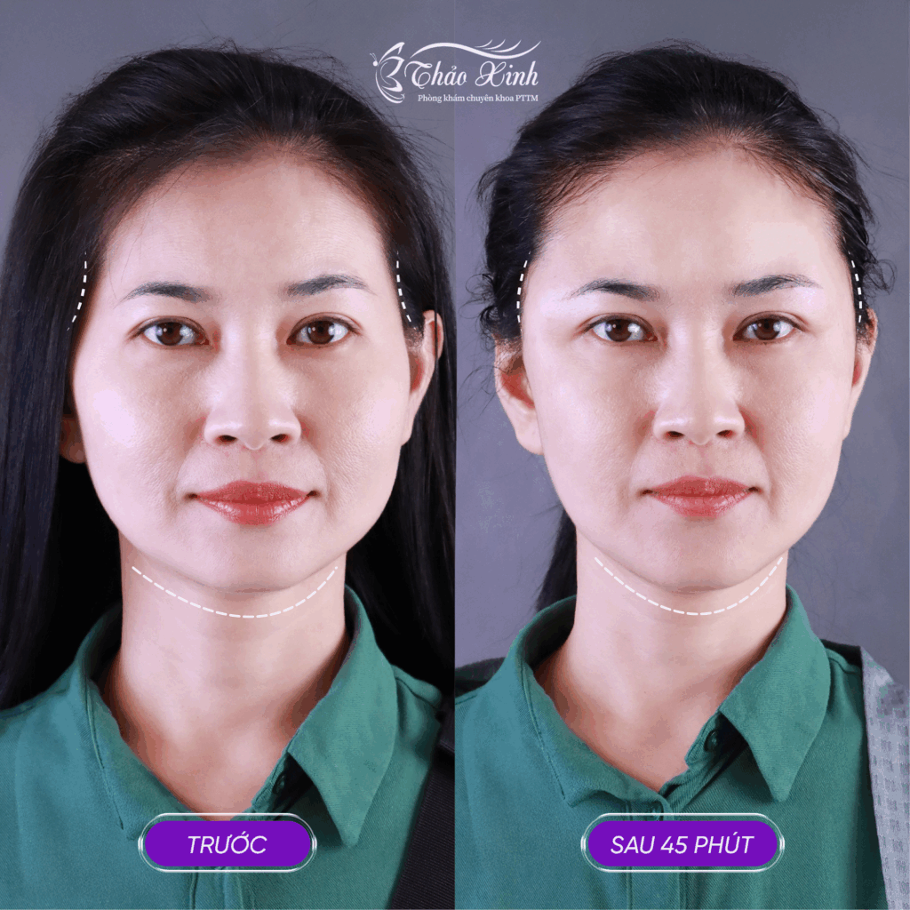 Độn Cằm Thái Dương 4