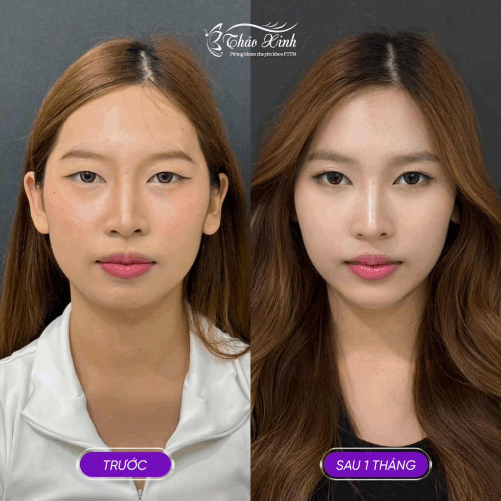 Độn Cằm V Line 5