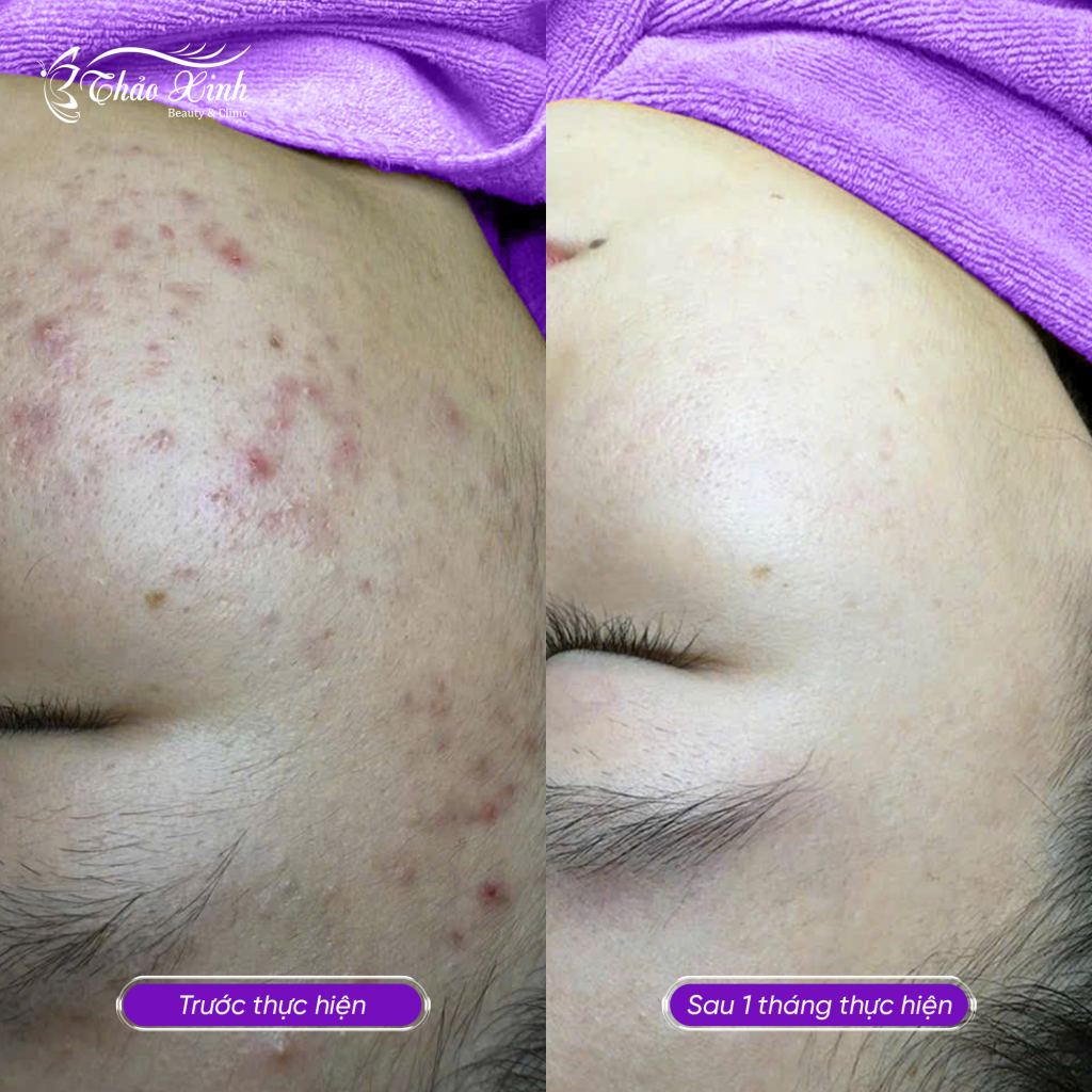 Điều Trị Mụn Thâm 6