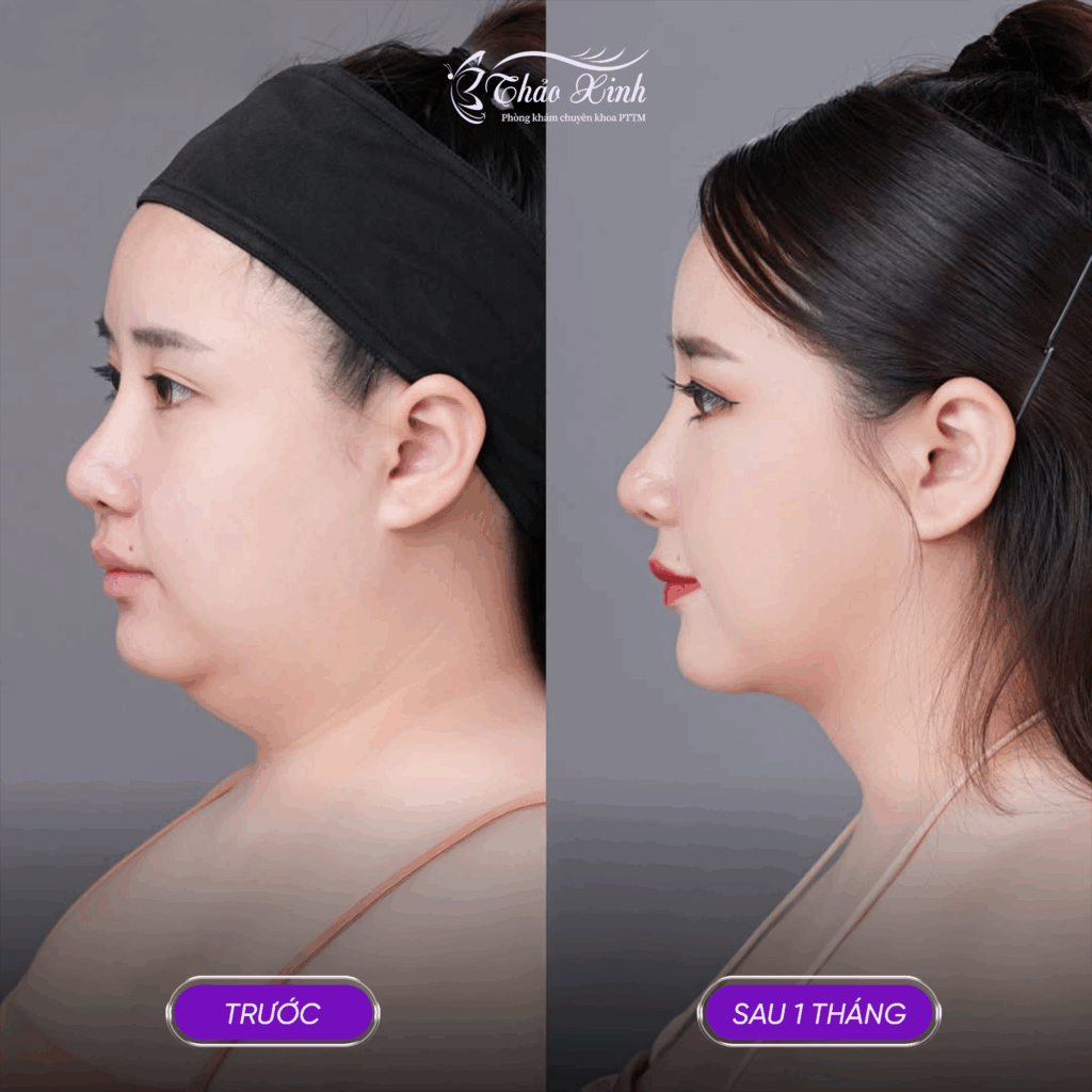 Lấy Mỡ Nọng Cằm 4