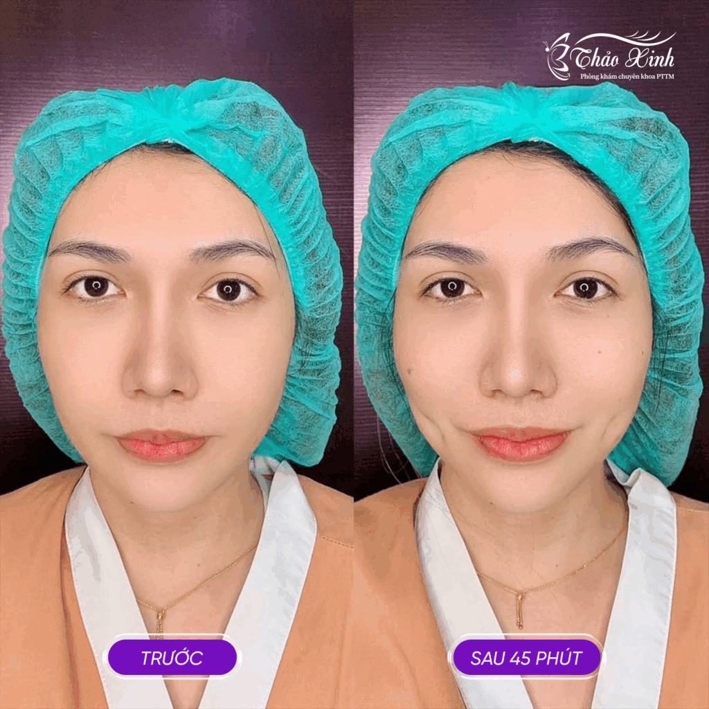 Tạo Má Lúm Đồng Tiền 5