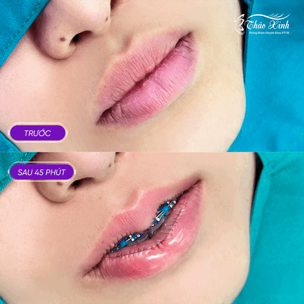 Tạo Hình Môi Dưới 5