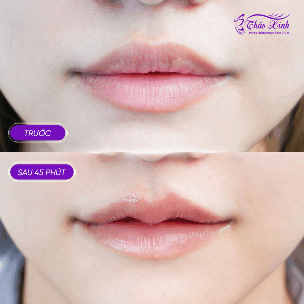 Tạo Hình Môi Trái Tim 5