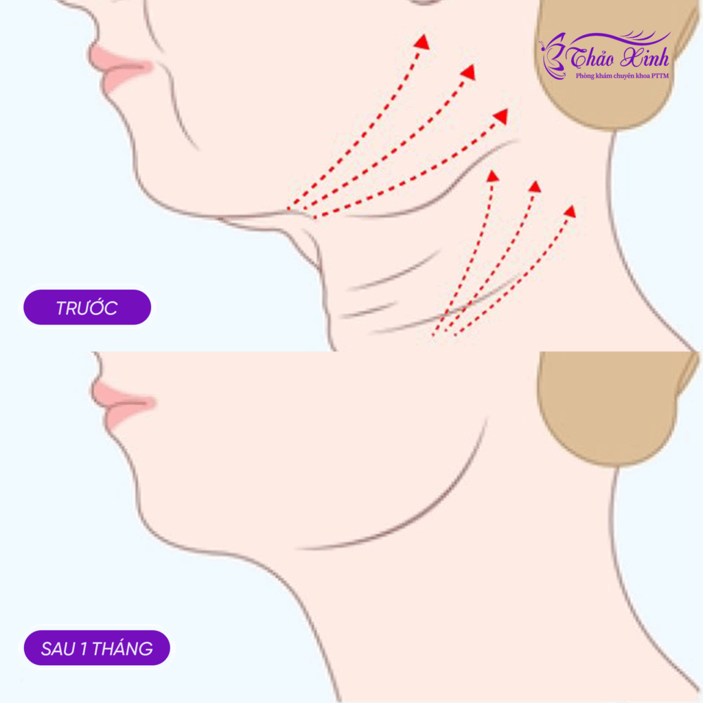 Căng Da Cổ Bán/Toàn Phần 6