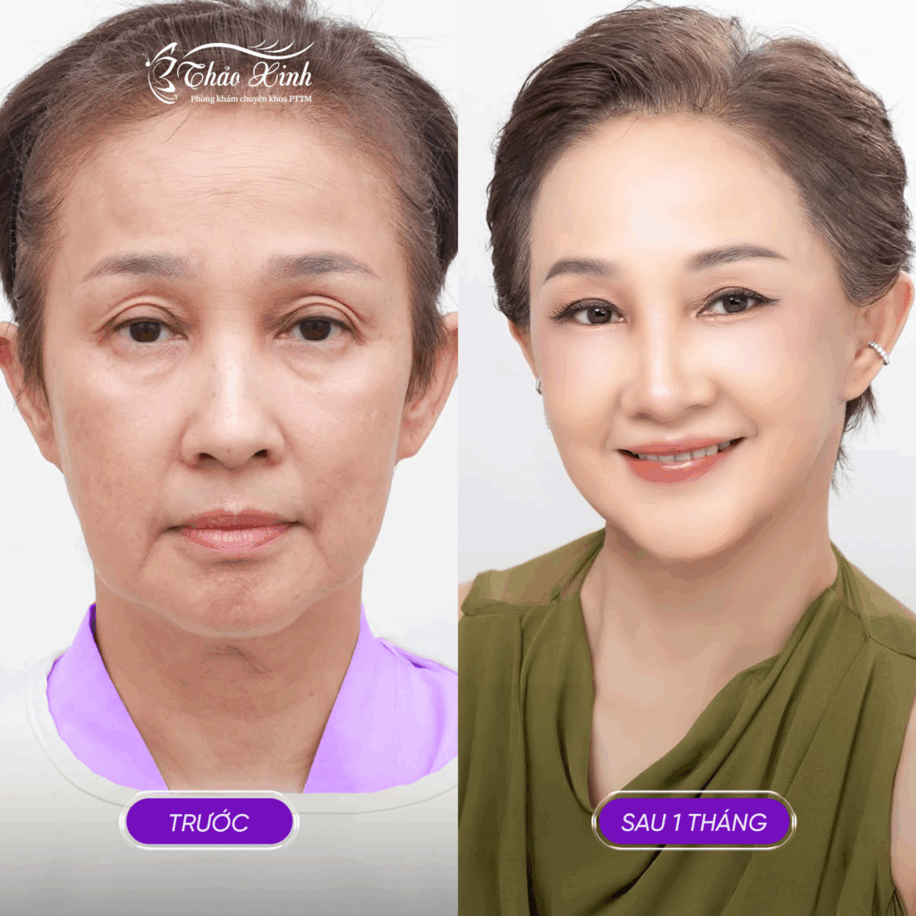 Căng Da Mặt Bán/Toàn Phần 3