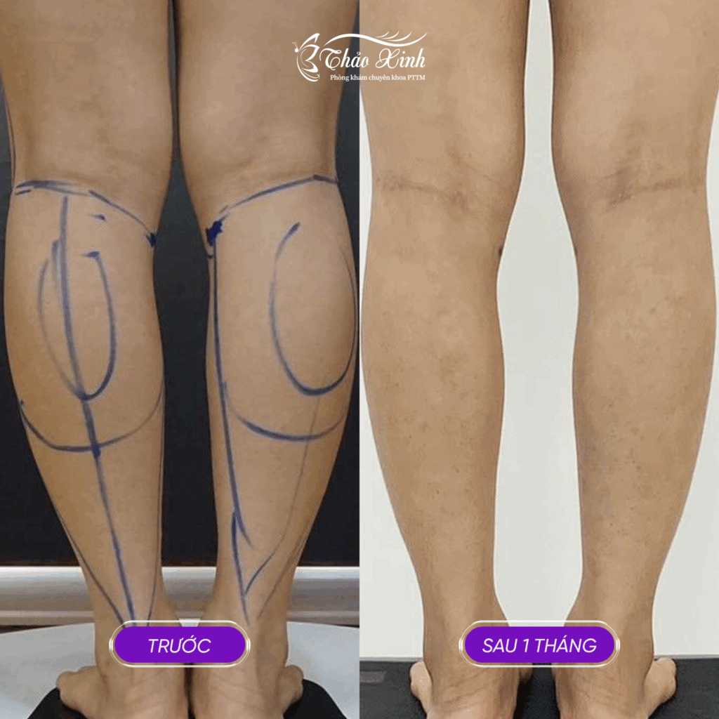 Hút Mỗ Vùng Bắp Chân 5