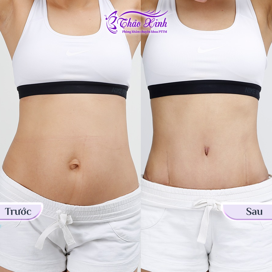 Căng Da Bụng Sau Sính Có Dời Rốn 5