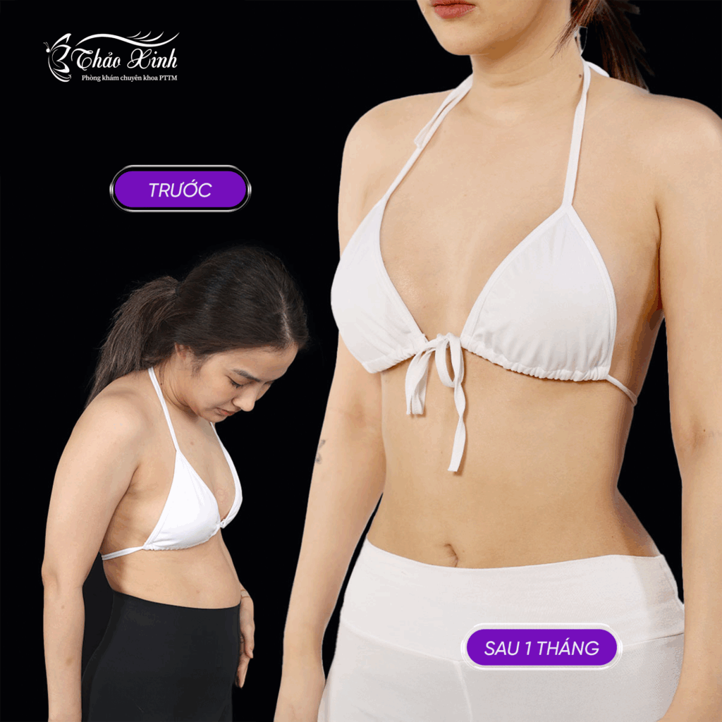 Căng Da Bụng Sau Sinh Không Dời Rốn 4