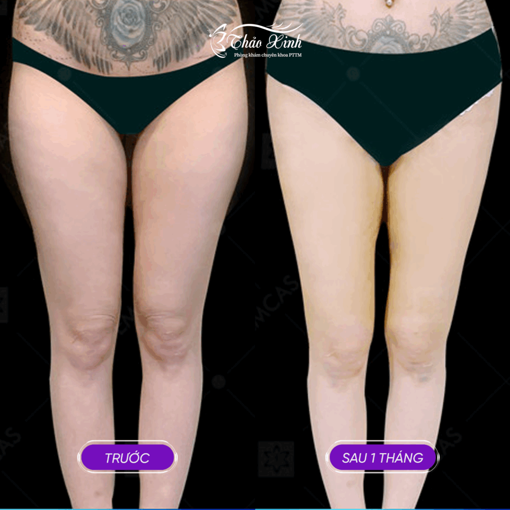 Hút Mỡ Vùng Đùi 4