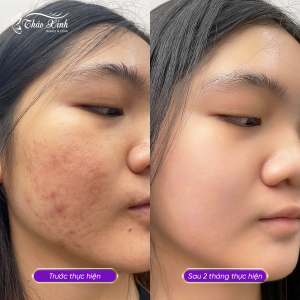 Điều Trị Mụn Bọc 28