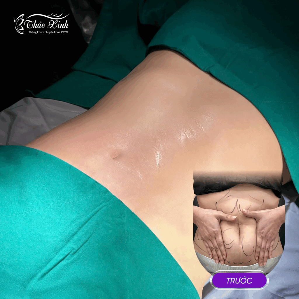 Hút Mỡ Vùng Bụng Trên/Dưới 5