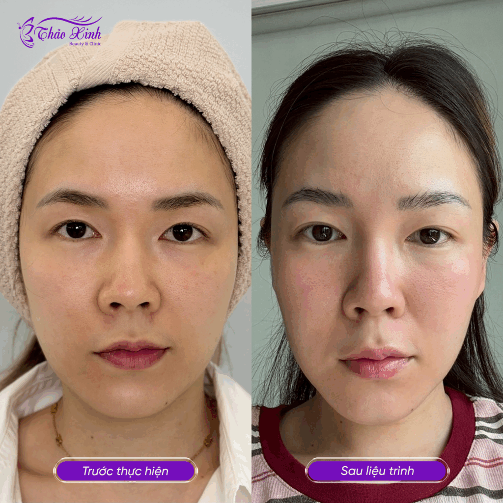 Chăm Sóc Da Chuyên Sâu 6