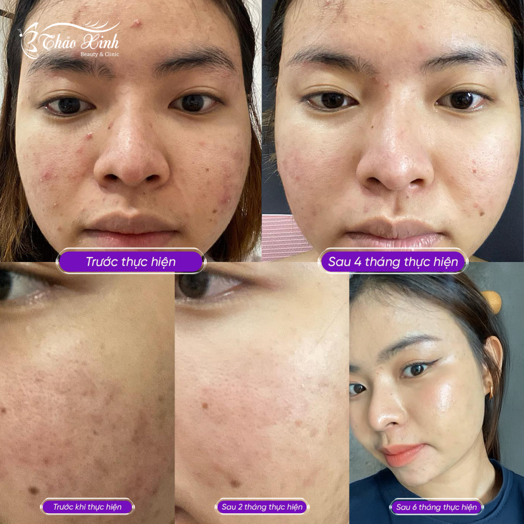 Điều Trị Mụn Dậy Thì 7