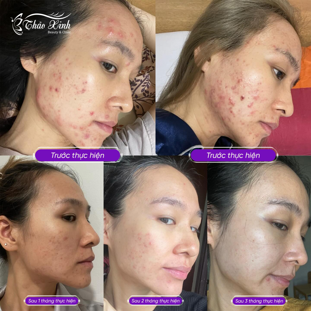 Điều Trị Mụn Trứng Cá 5