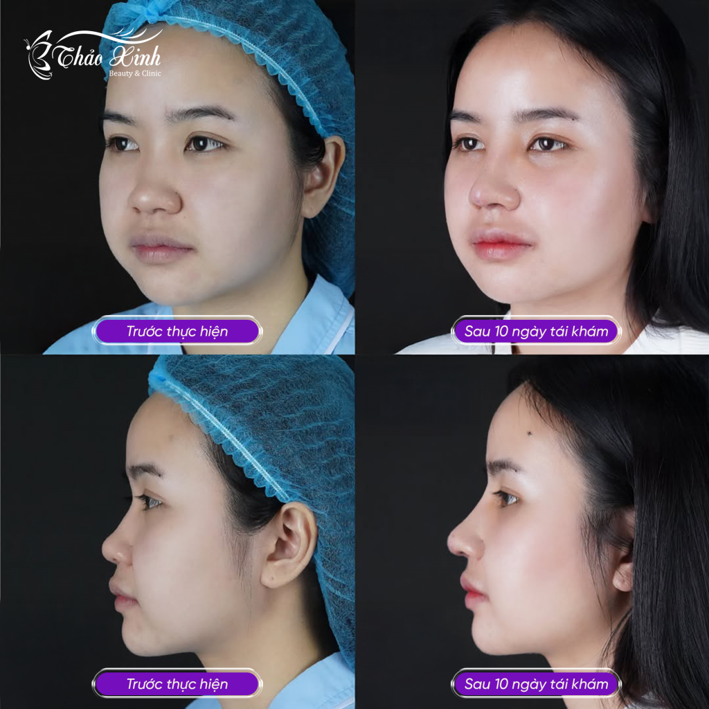 Nâng Mũi Sụn Hàn Quốc 4