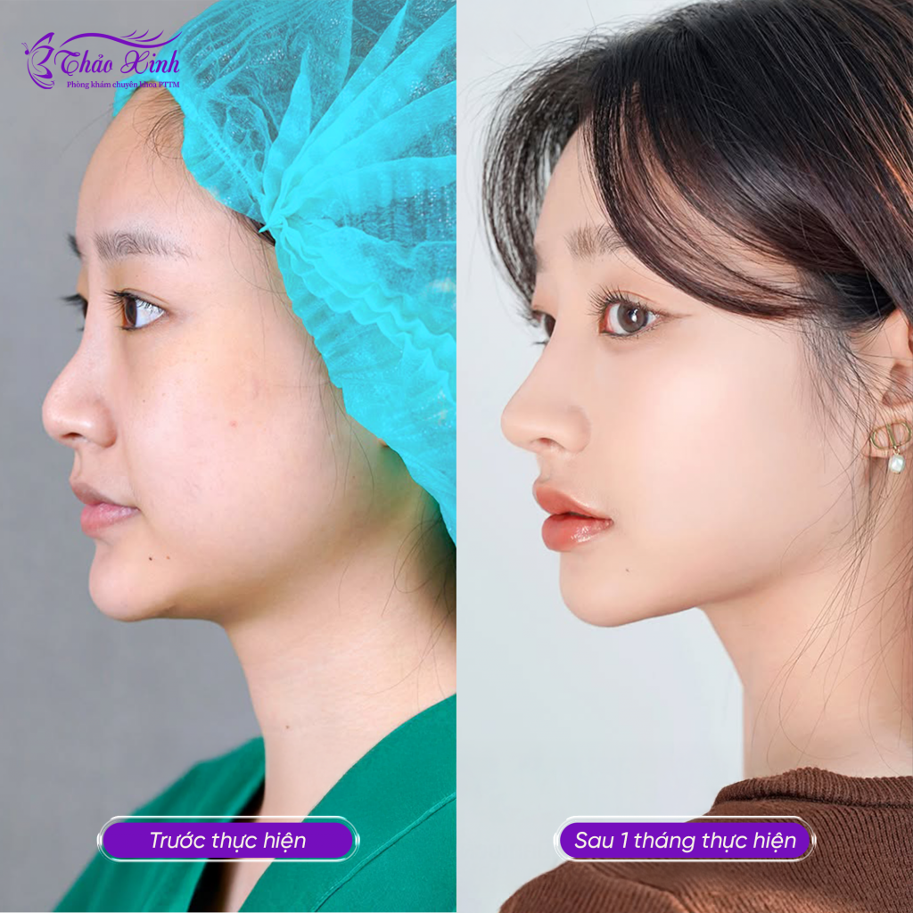 Nâng Mũi Sụn Surgiform 5