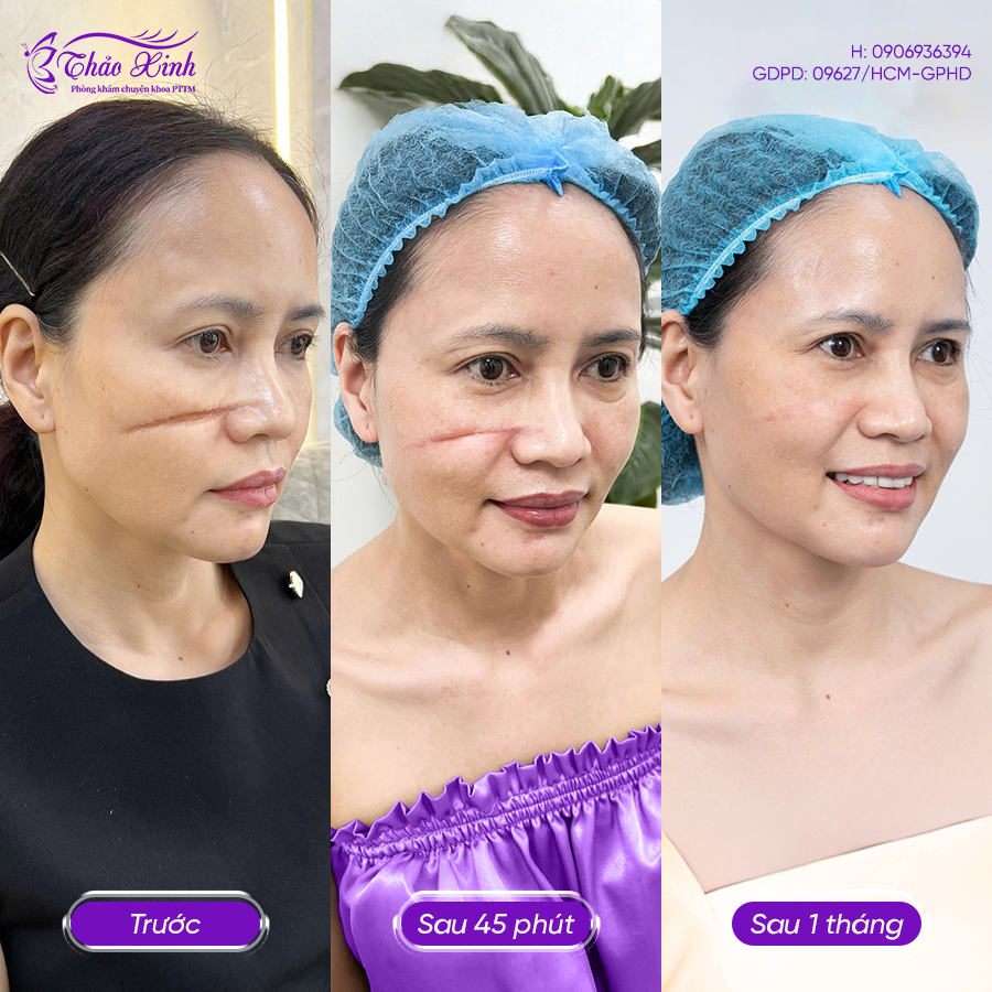 Điều Trị Sẹo Lồi 4