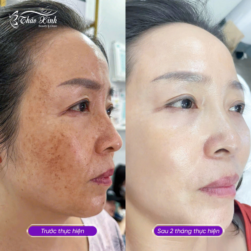 Điều Trị Nám Mảng 5