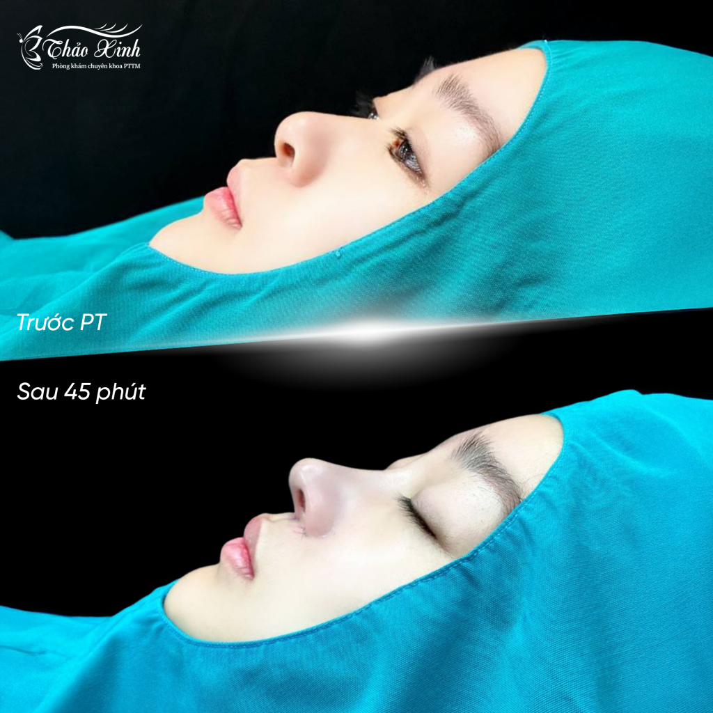 Nâng Mũi Cấu Trúc Kín 6