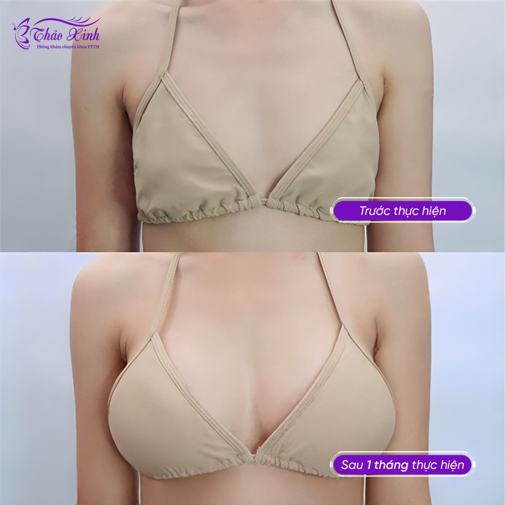 Nâng Ngực Túi Nhám 3