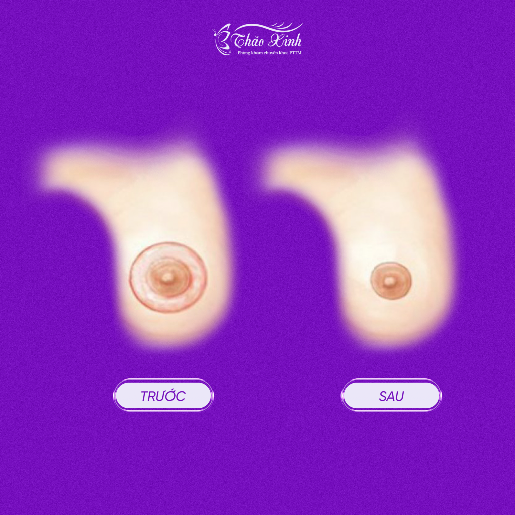 Thu Nhỏ Quầng/Đầu Ngực 8