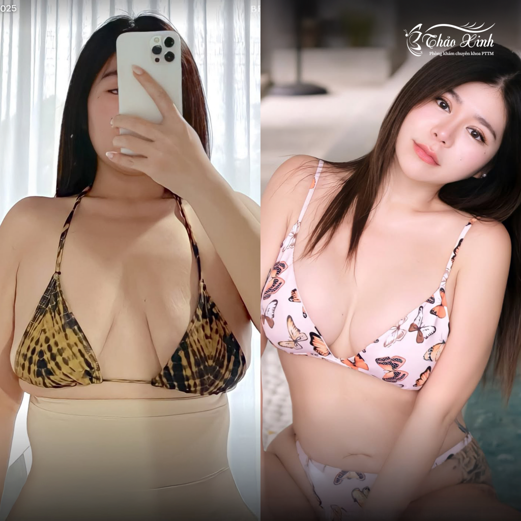 Treo Sa Trễ Chỉnh Hình Ngực 4