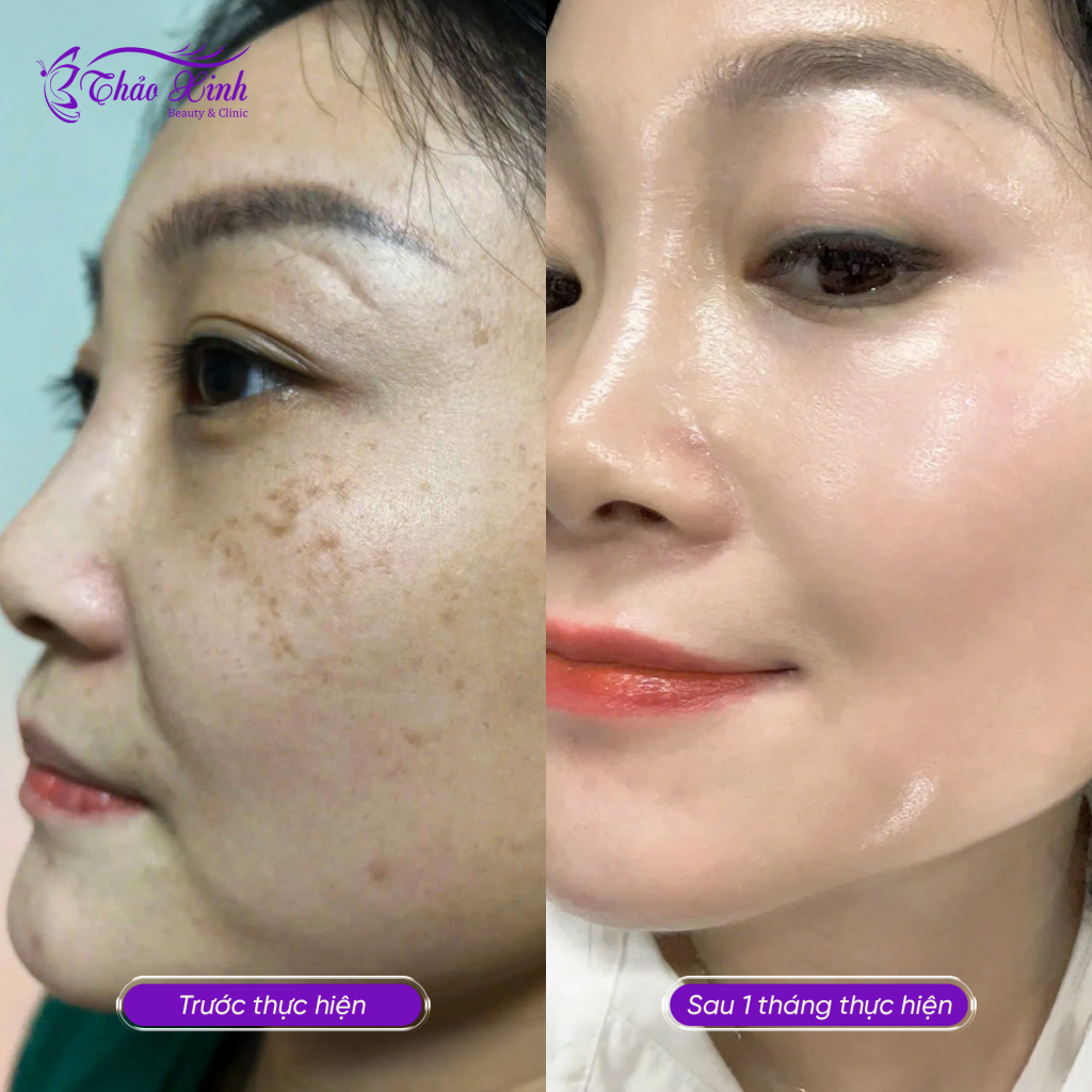Điều Trị Nám Đốm "Bớt Hori" 6