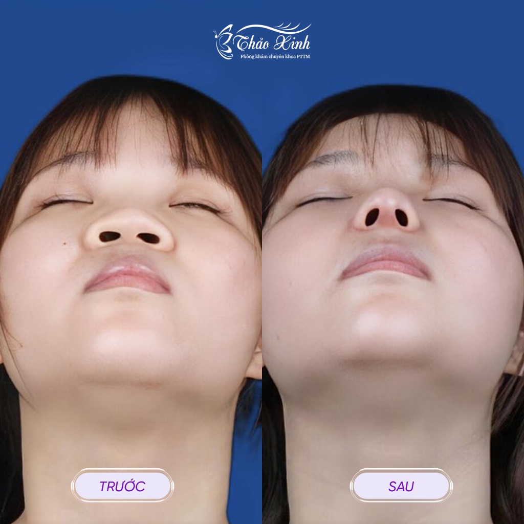 Thu Gọn Đầu Mũi 6