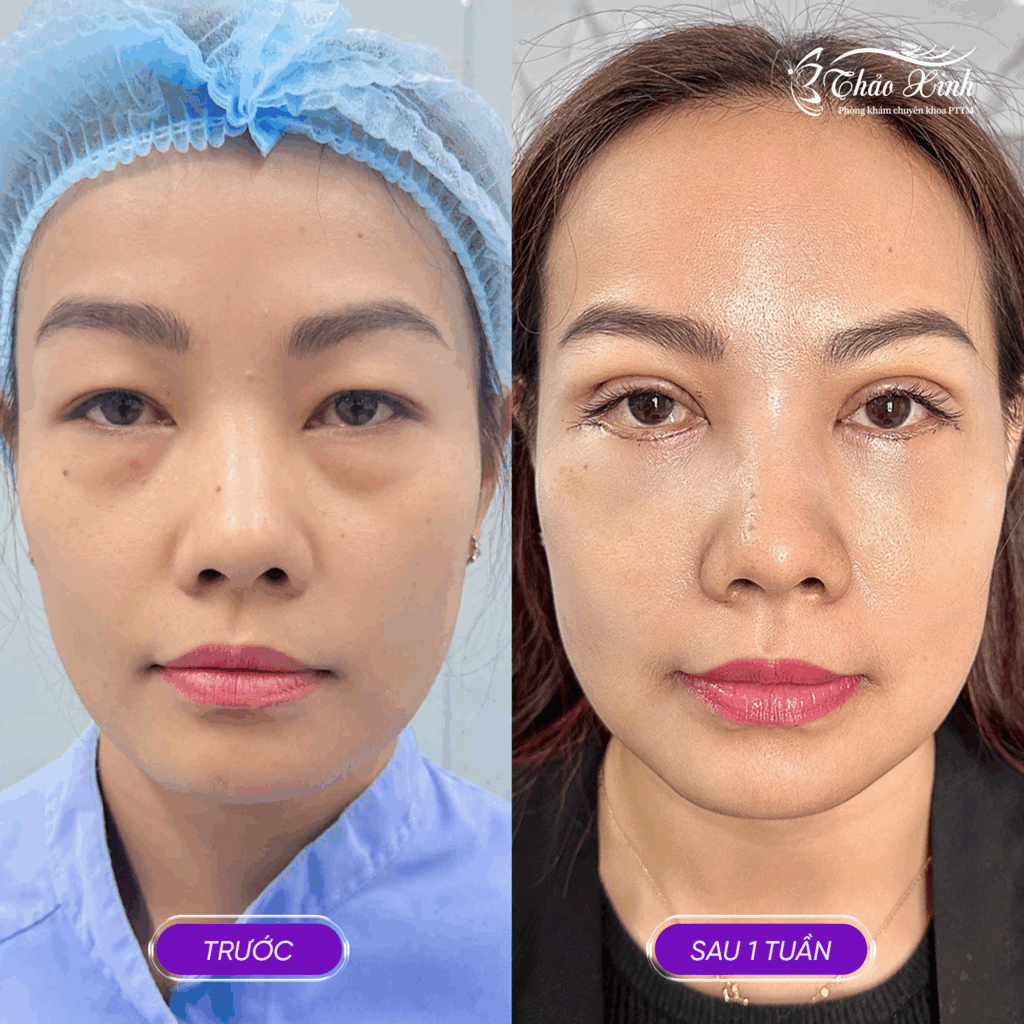 Cắt Mắt Hai Mí Trên, Mí Dưới 4