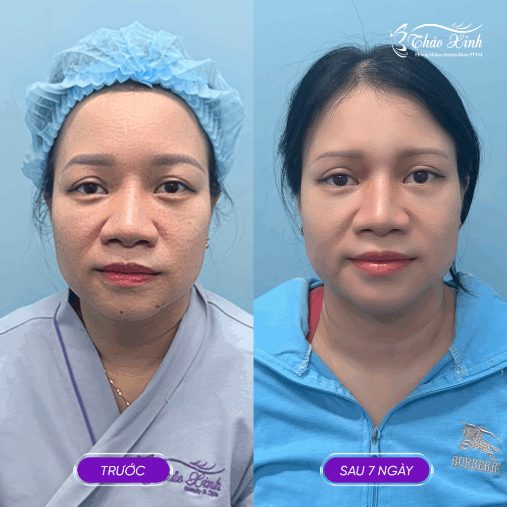 Nâng Cung Mày Cơ Bản 4