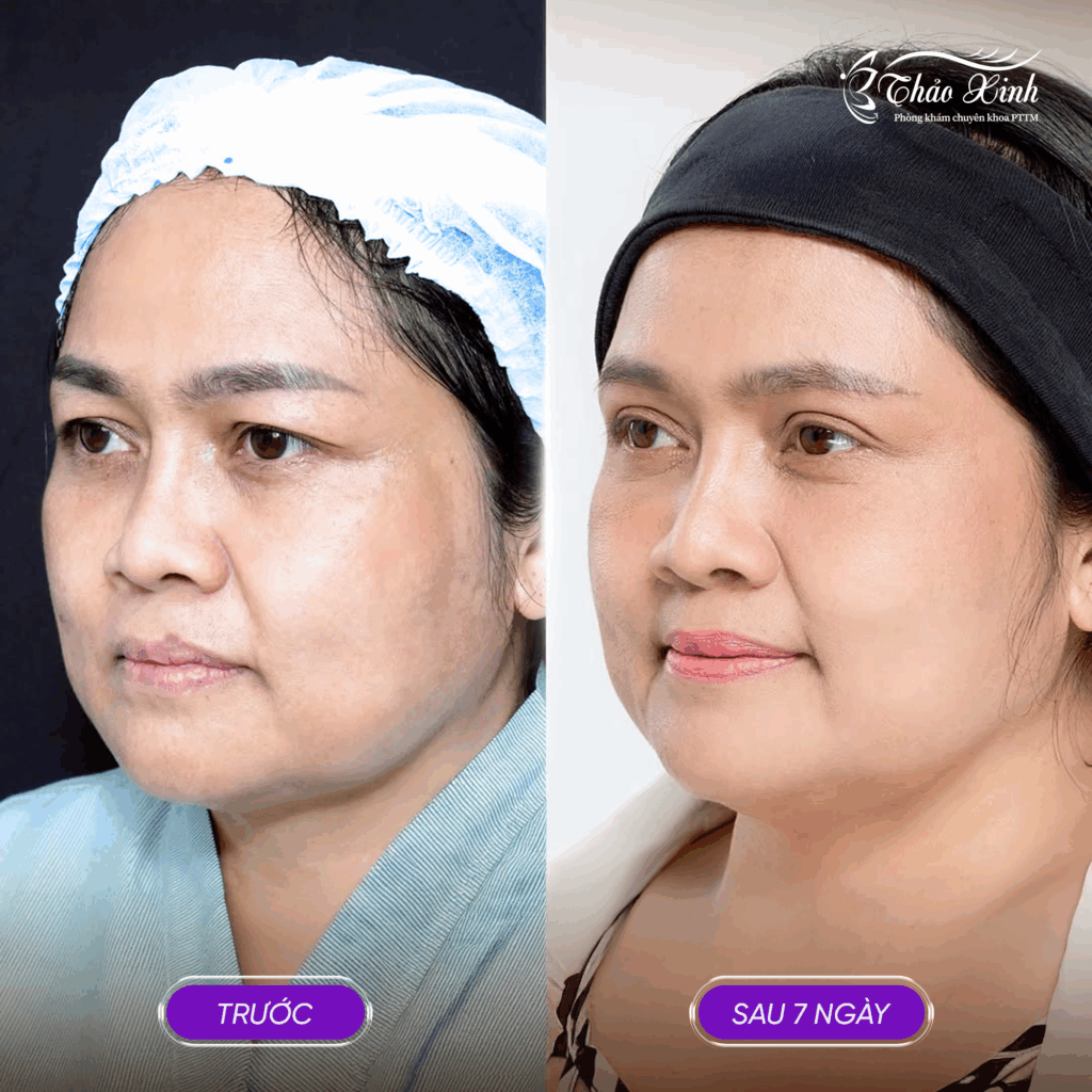 Nâng Cung Mày Rút Chỉ 6