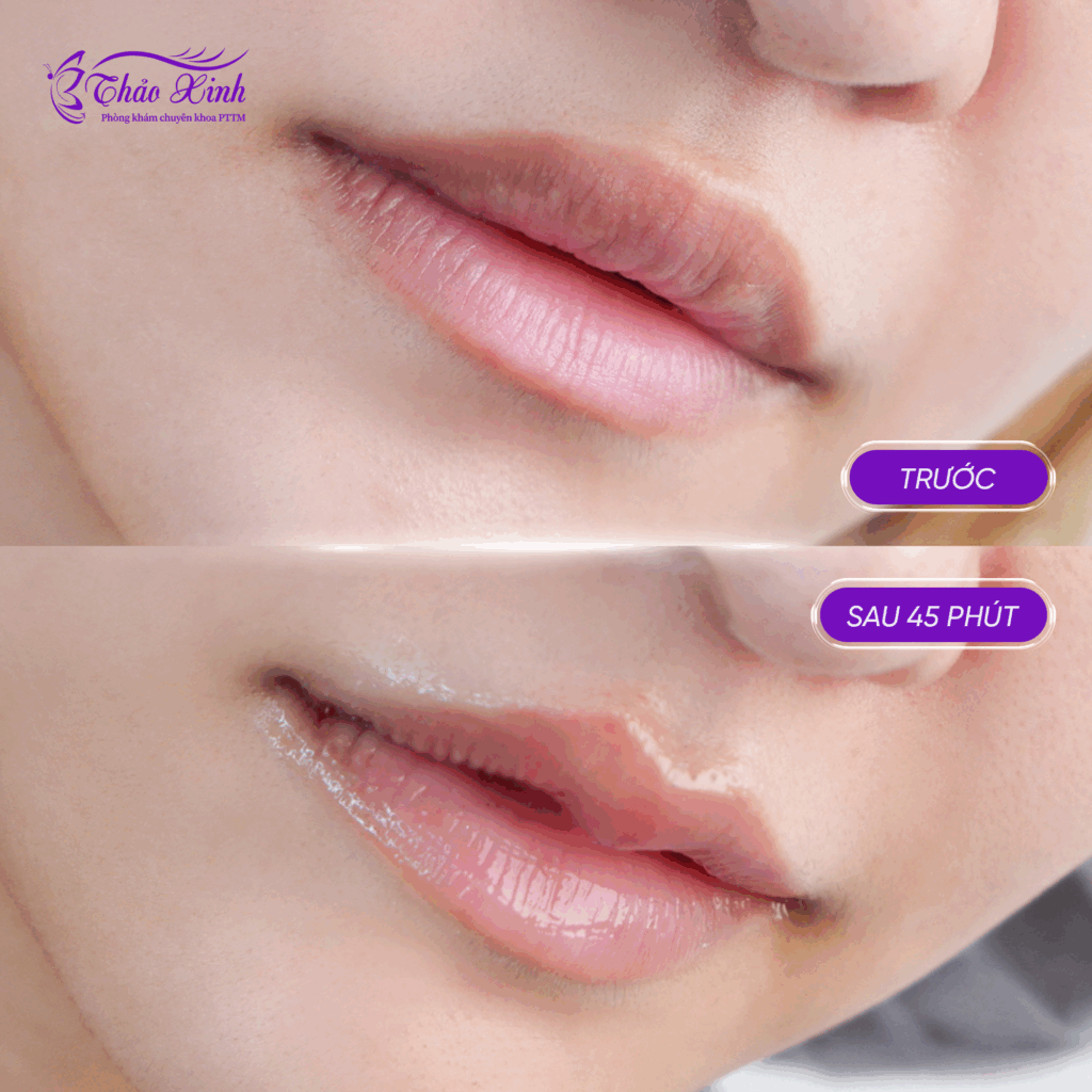 Tạo Hình Môi Trên 6