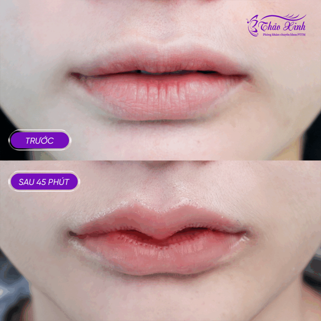 Tạo Hình Môi Dưới 4