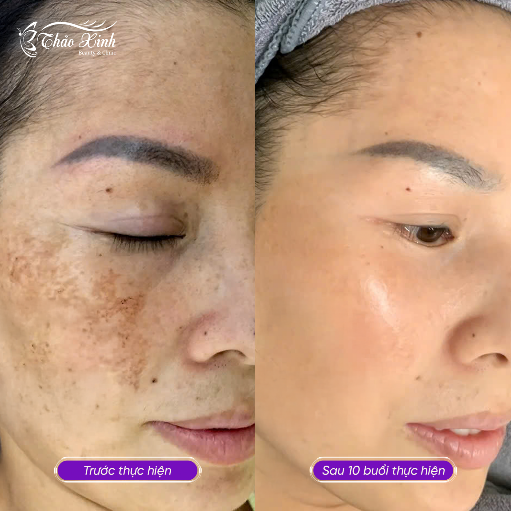 Điều Trị Nám Tổng Hợp 8