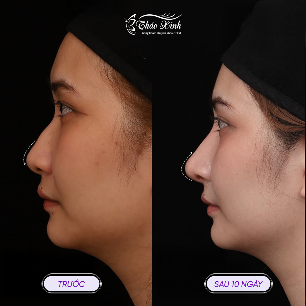 Cà Gồ Mũi 6