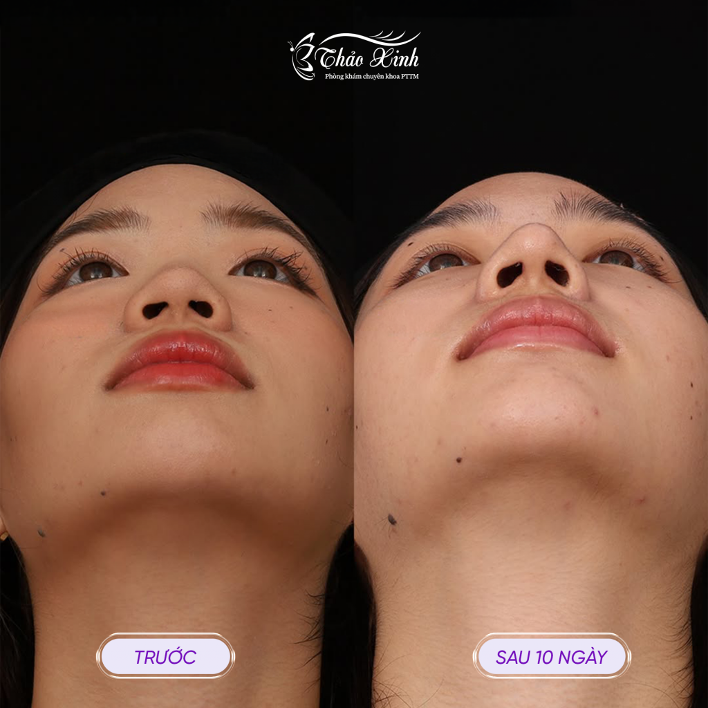 Tạo Hình Lỗ Mũi Hạt Chanh 8
