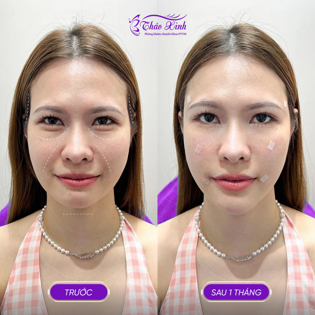 Làm Đầy Rãnh Cười Tự Thân 6