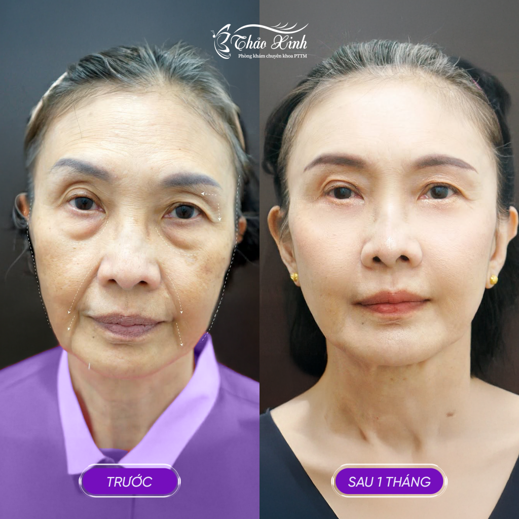 Cấy Mỡ Má Tự Thân 6