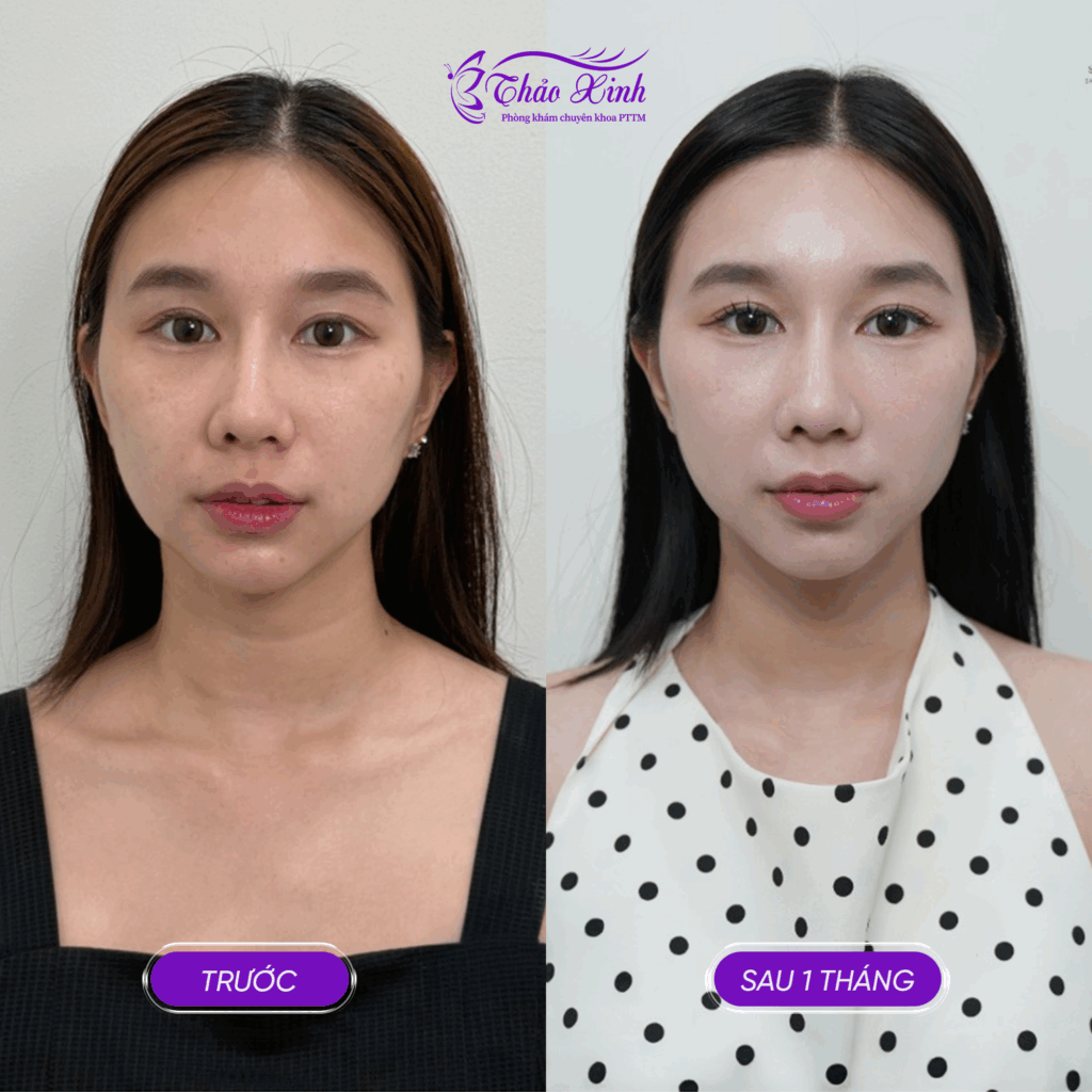 Căng Da Cổ Bán/Toàn Phần 5