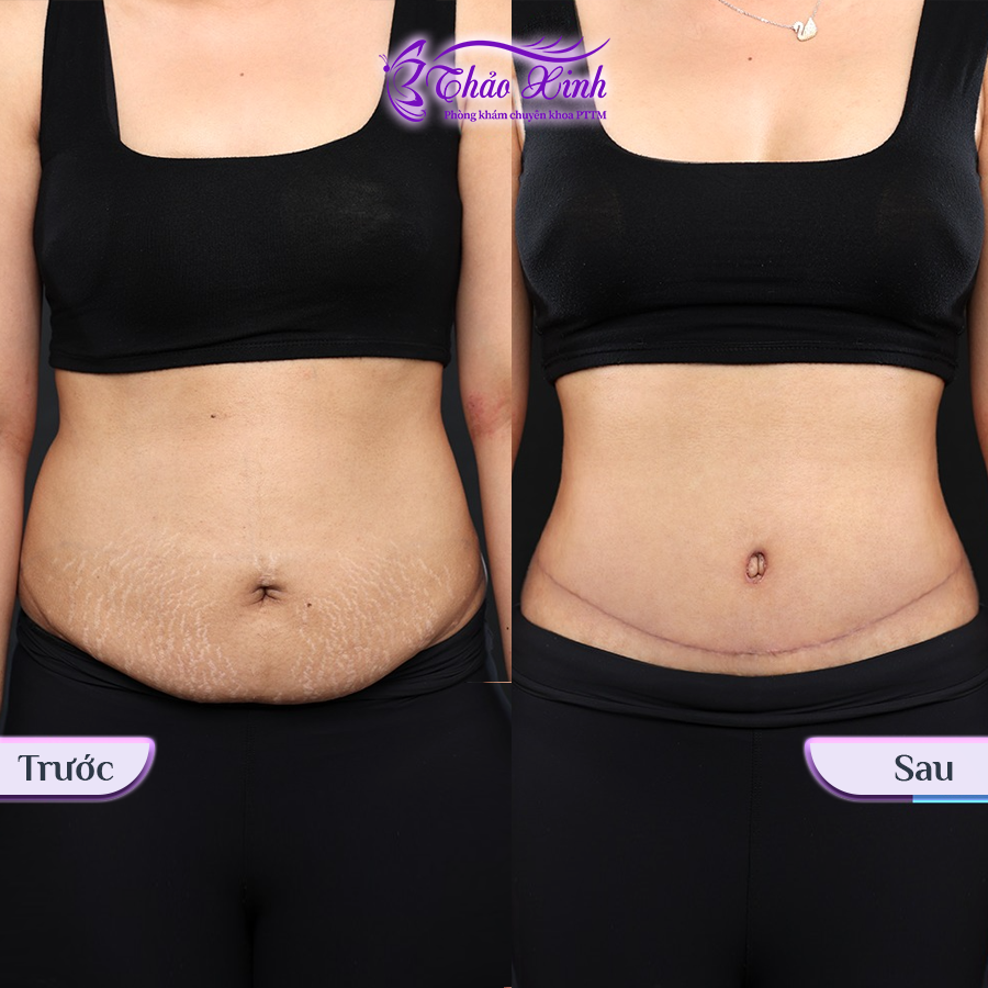 Căng Da Bụng Sau Sính Có Dời Rốn 4