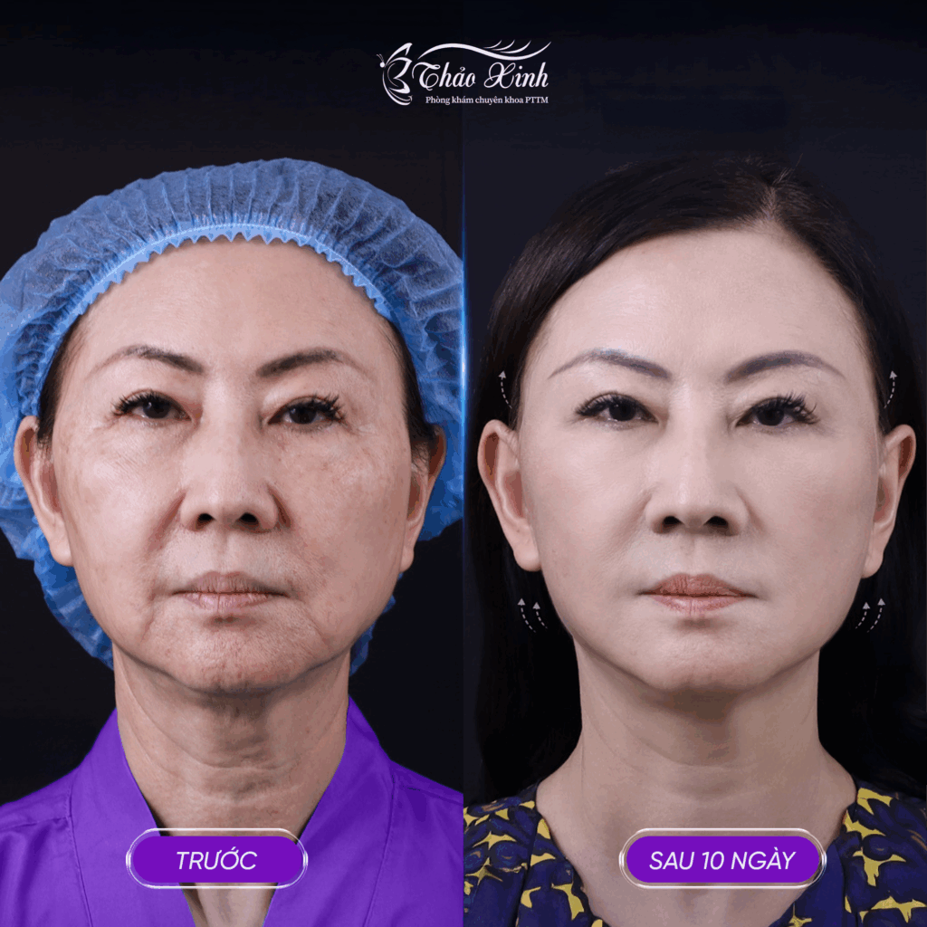 Căng Da Mặt Smas Face 6