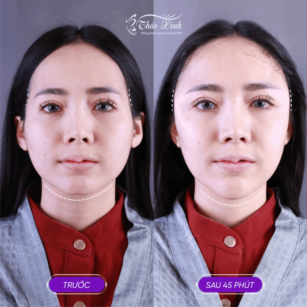 Độn Cằm Thái Dương 6