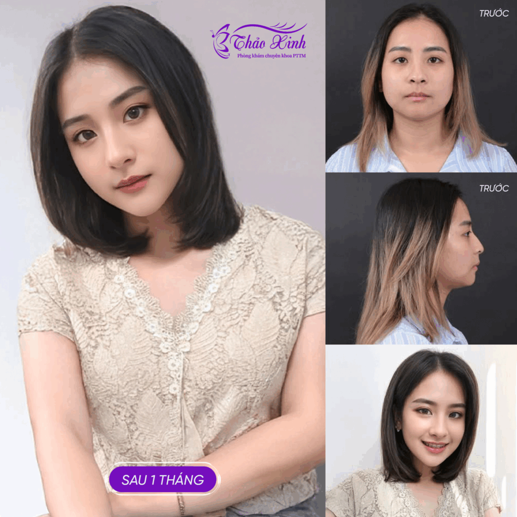 Độn Cằm V Line 4