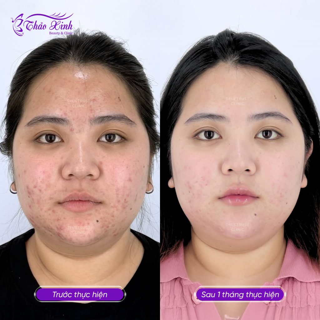 Điều Trị Mụn Thâm 5